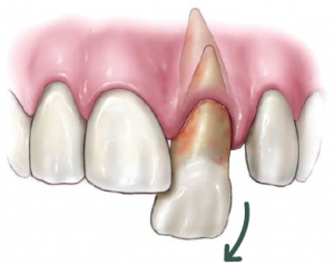 Chấn thương khiến răng chồi ra